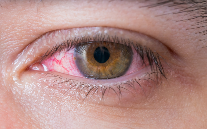 alergiczne zapalenie spoj&oacute;wek