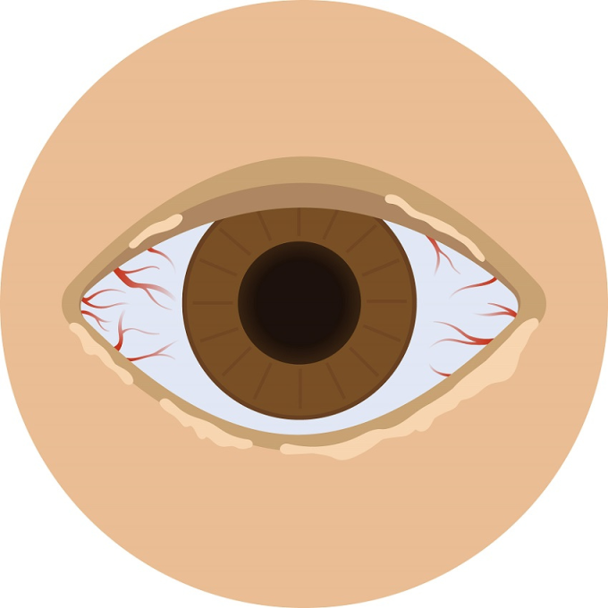 Nadmierny łojotok zapalenia brzeg&oacute;w powiek