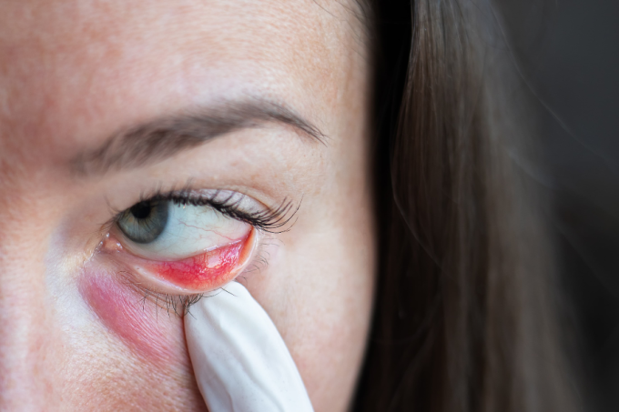 Szkła kontaktowe mogą przemieszczać się po powierzchni gałki ocznej. Czasami zdarza się też, że soczewka utknie pod powieką. Czy taka soczewka może zawędrować głębiej i wpaść za oko?