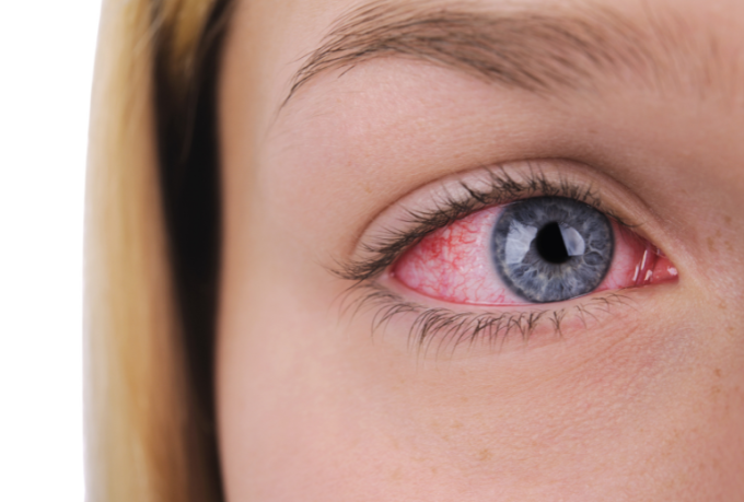 Zapalenie spoj&oacute;wek - rodzaje, profilaktyka, leczenie